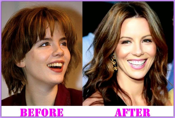 Kate-Beckinsale-Plastic-Surgery-before-after.jpg