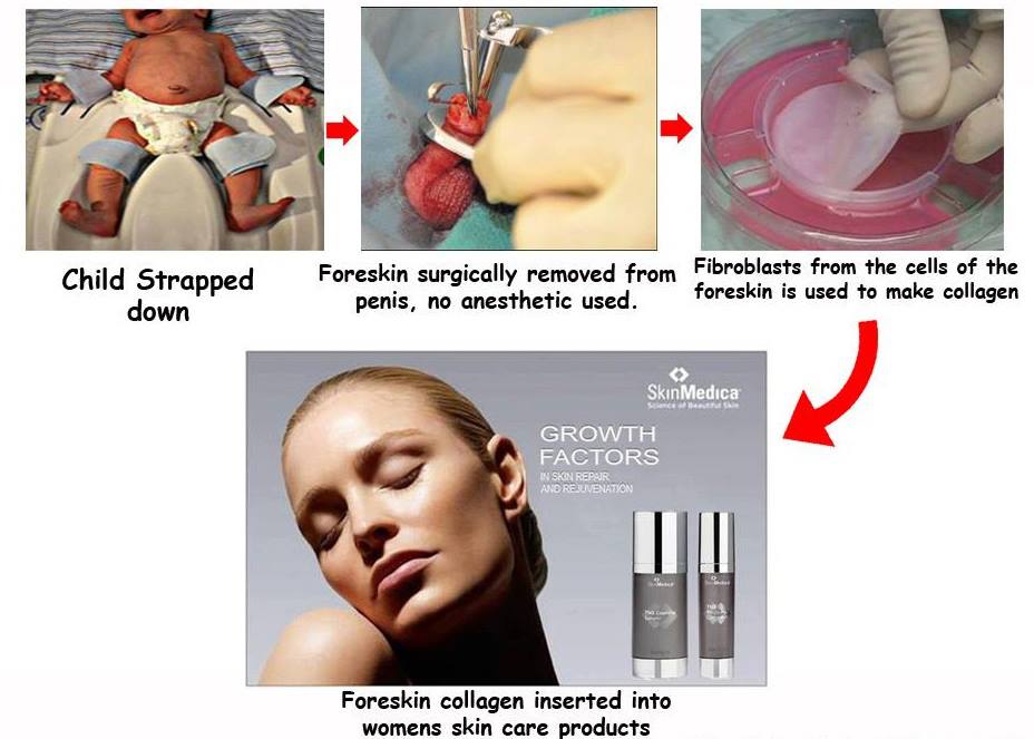 The-Process-of-foreskin-harvesting-for-cosmetics.jpg