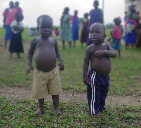 two-kids-swollen-belly.jpg